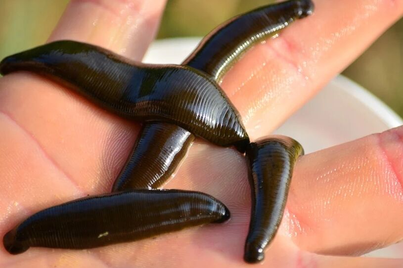 Leeches hëllefen am Kampf géint Krampfadern