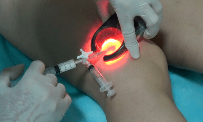Sklerotherapie ass eng efficace Method vun der Behandlung vun Krampfadern op de Been